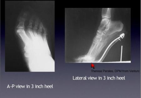 xray of foot in 3 inch heel