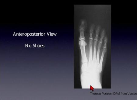 xray of normal foot 