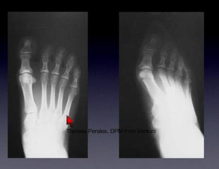 xray comparison of feet